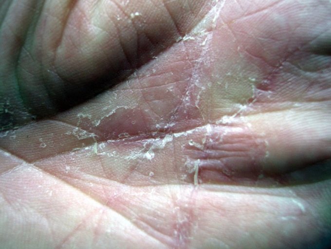 Hand mit einer Pilzinfektion durch Trichophyton rubrum